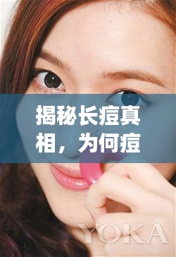 揭秘長痘真相，為何痘痘反復(fù)來襲？根源解析！