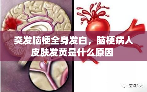 突發(fā)腦梗全身發(fā)白，腦梗病人皮膚發(fā)黃是什么原因 