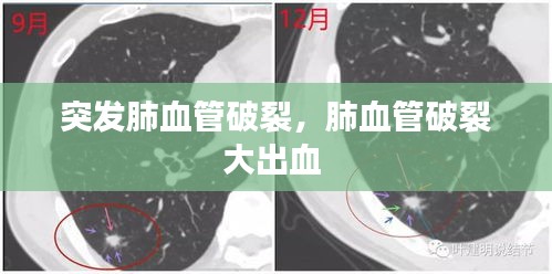 突發(fā)肺血管破裂，肺血管破裂大出血 
