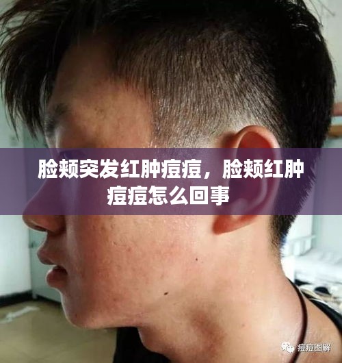 臉頰突發(fā)紅腫痘痘，臉頰紅腫痘痘怎么回事 
