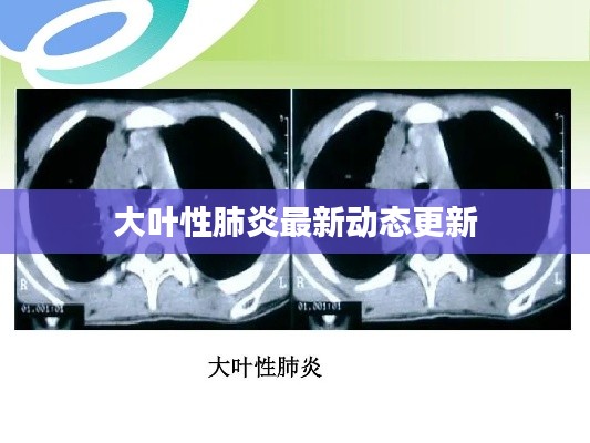 大葉性肺炎最新動態(tài)更新